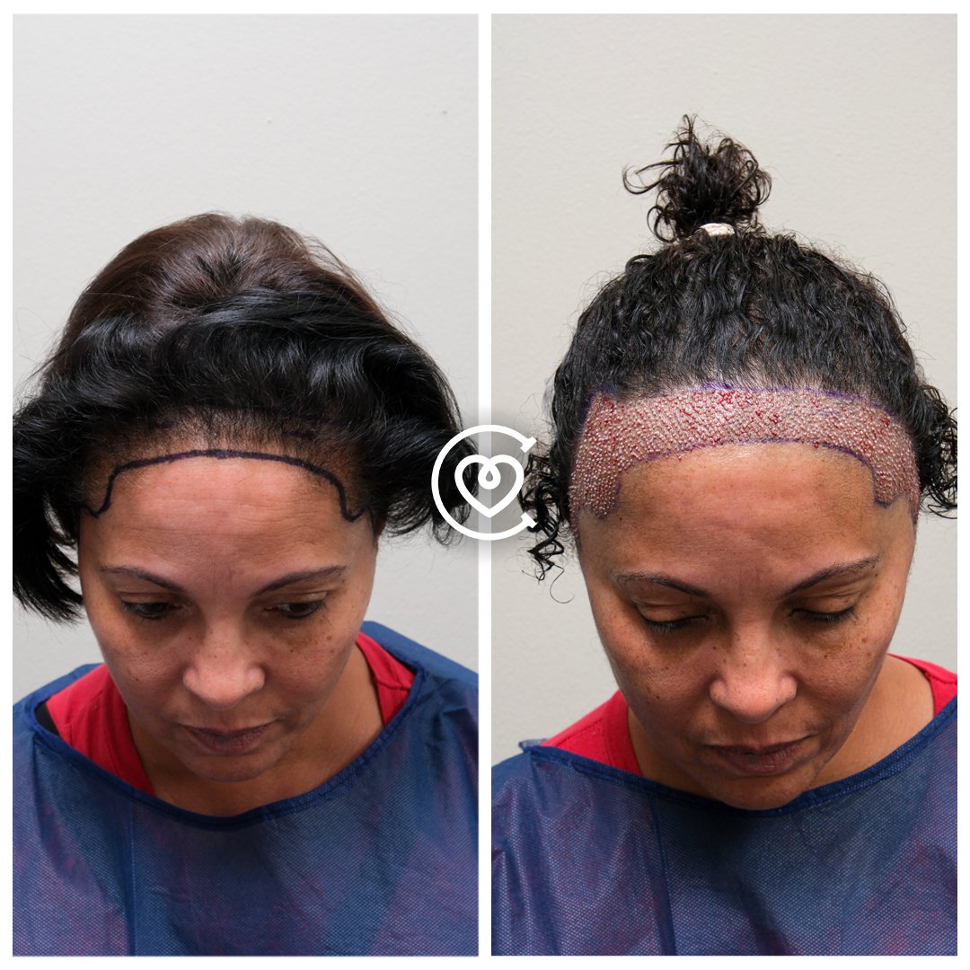 زراعة الشعر للنساء