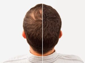 زراعة الشعر بدون حلاقة: أسباب تجعلها الخيار المثالي 2026