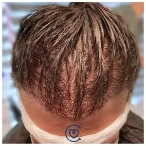 زراعة الشعر بدون حلاقة في عيادة كايرا