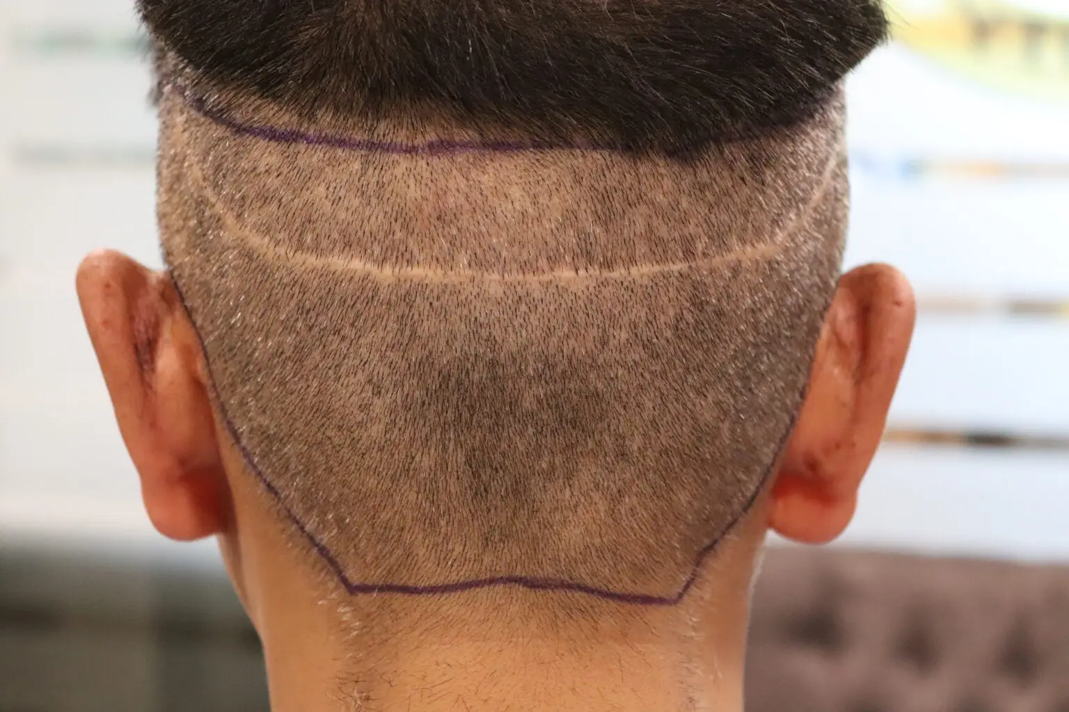 FUE مقابل FUT في زراعة الشعر