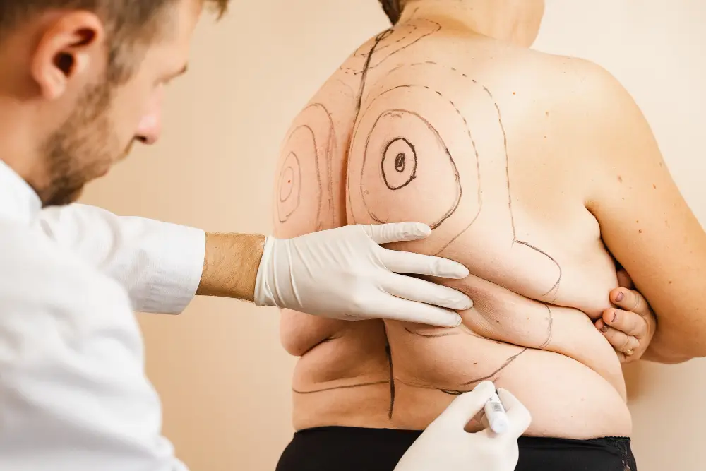 شفط الدهون في إسطنبول