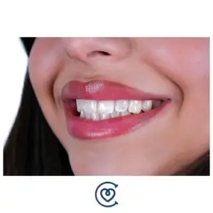 تلبيسات الاسنان
