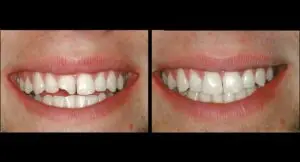 علاج الأسنان المكسورة