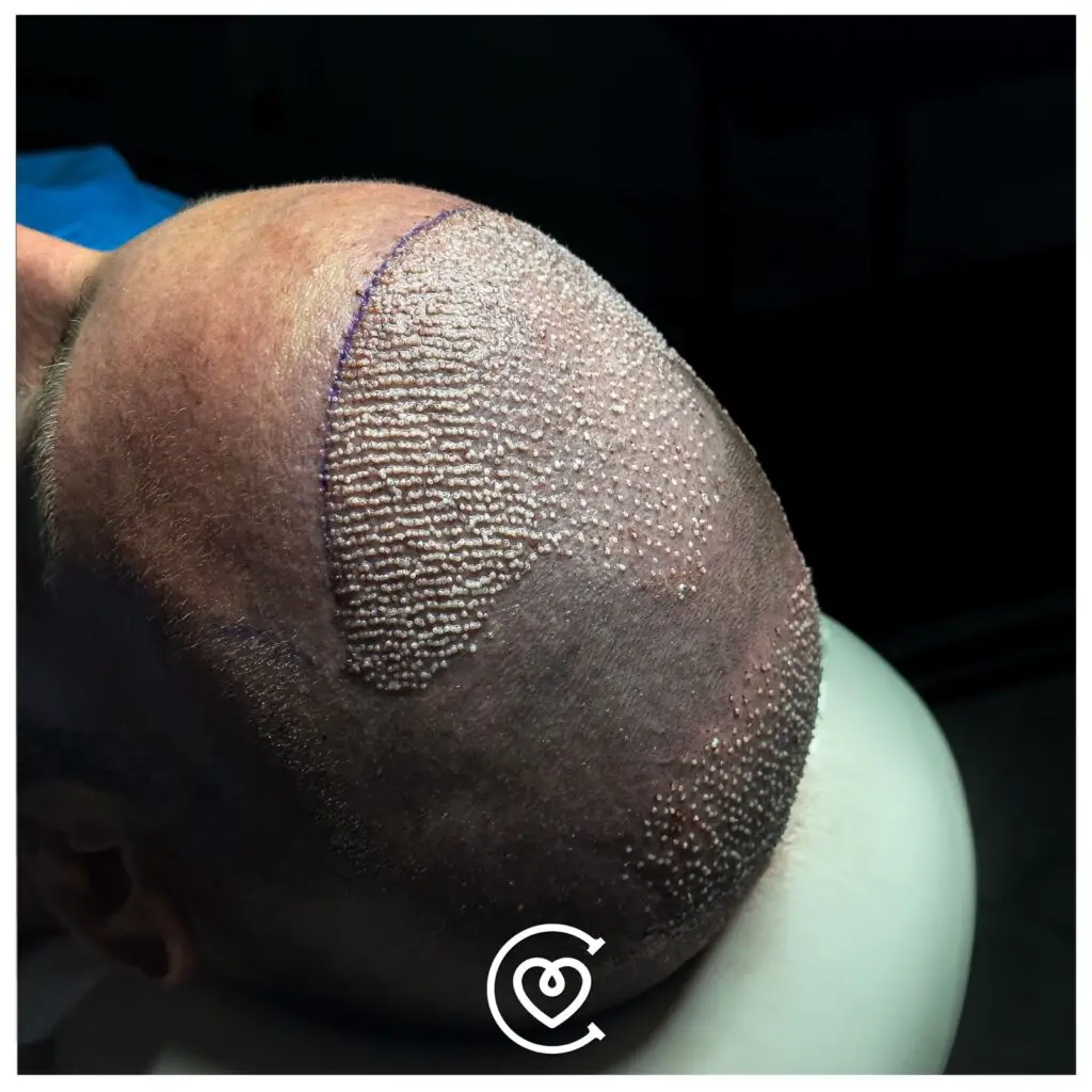 زراعة الشعر