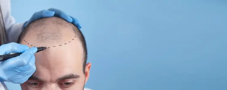 زراعة الشعر