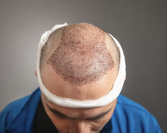 زراعة الشعر للمشاهير