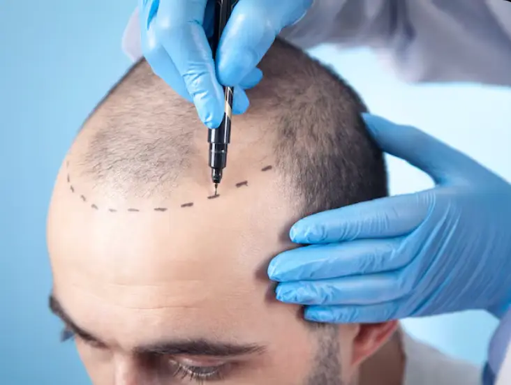 زراعة الشعر للمشاهير