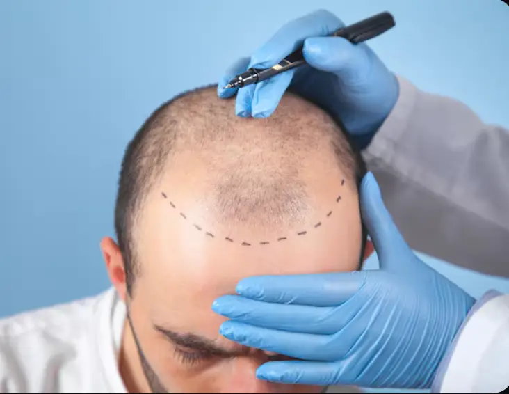 زراعة الشعر 2025: أفضل عياده في السلطان أحمد بإسطنبول