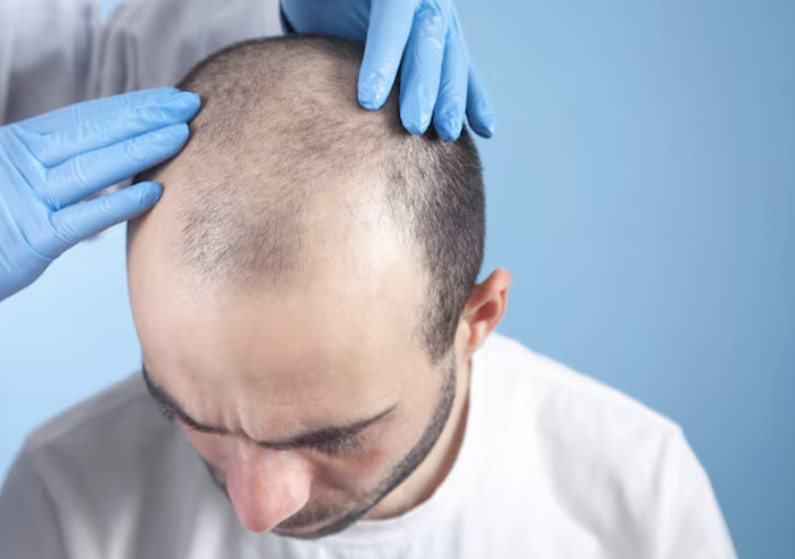 زراعة الشعر في بيليك