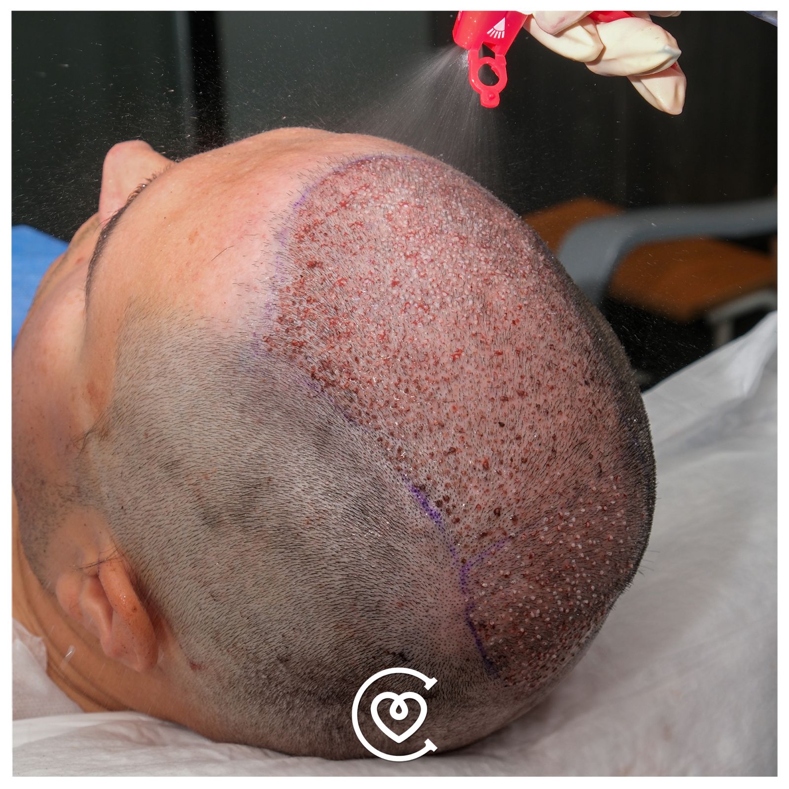 زراعة الشعر