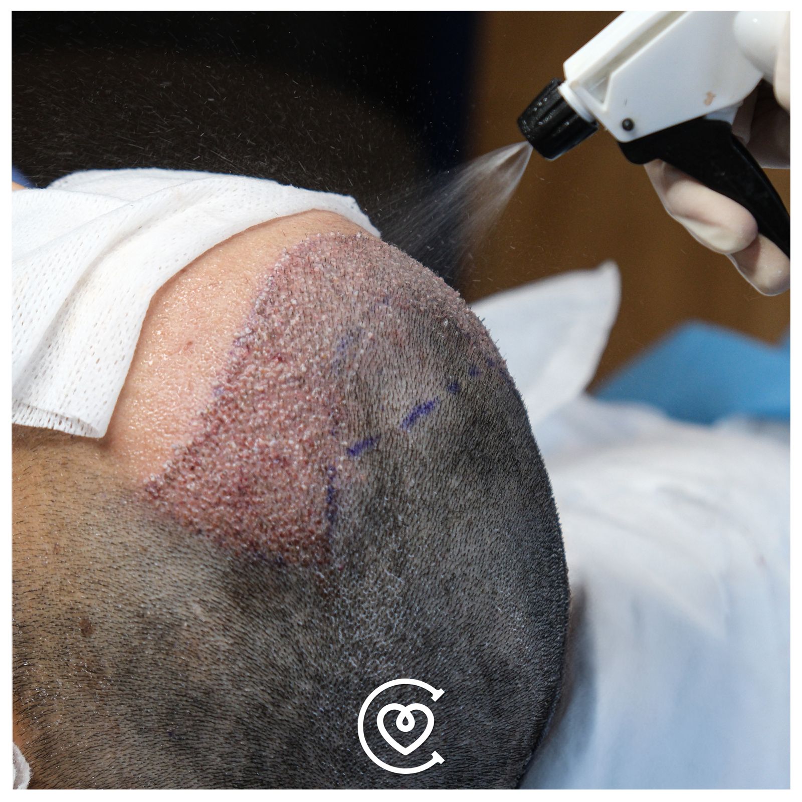 زراعة الشعر