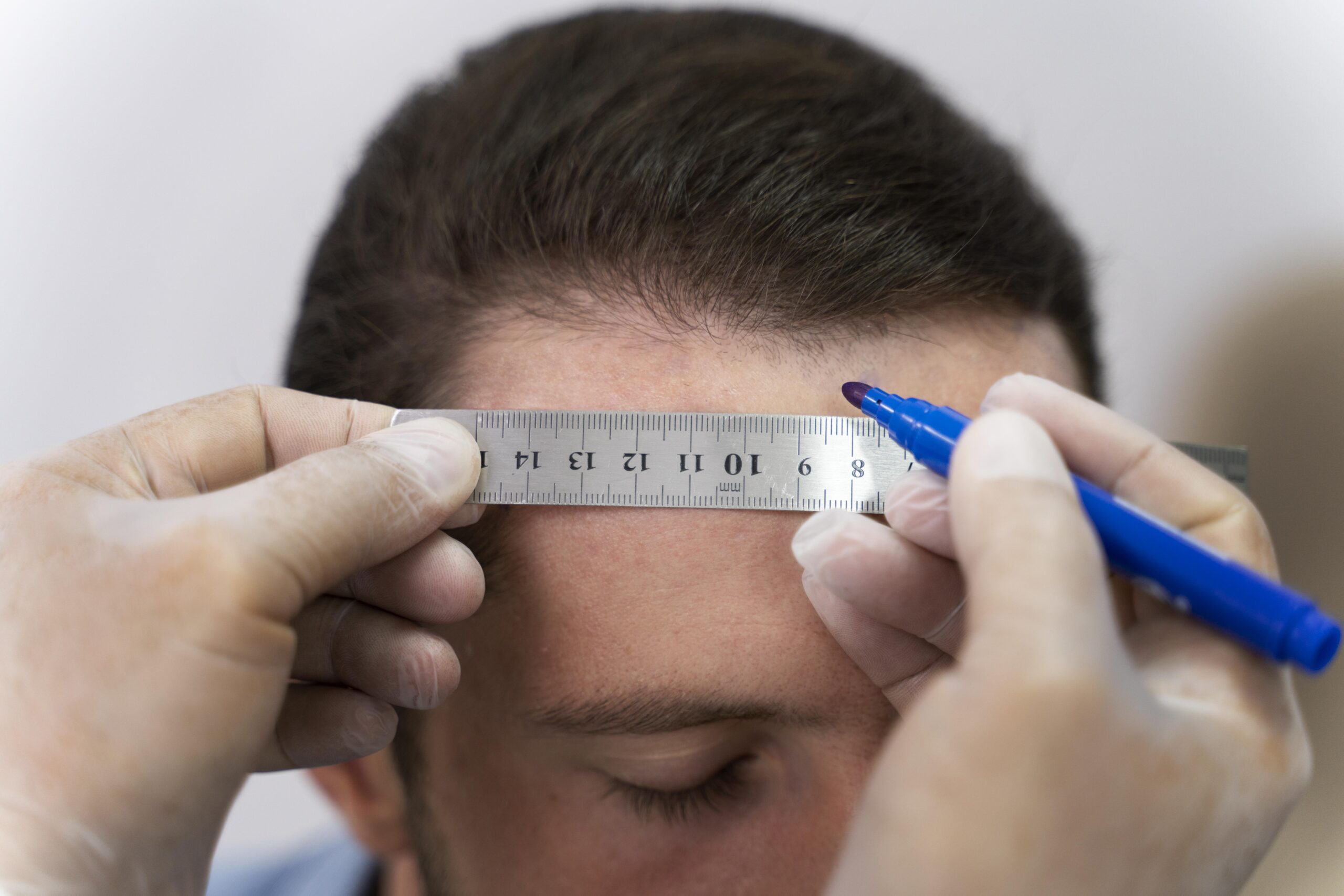 زراعة الشعر في الانيا