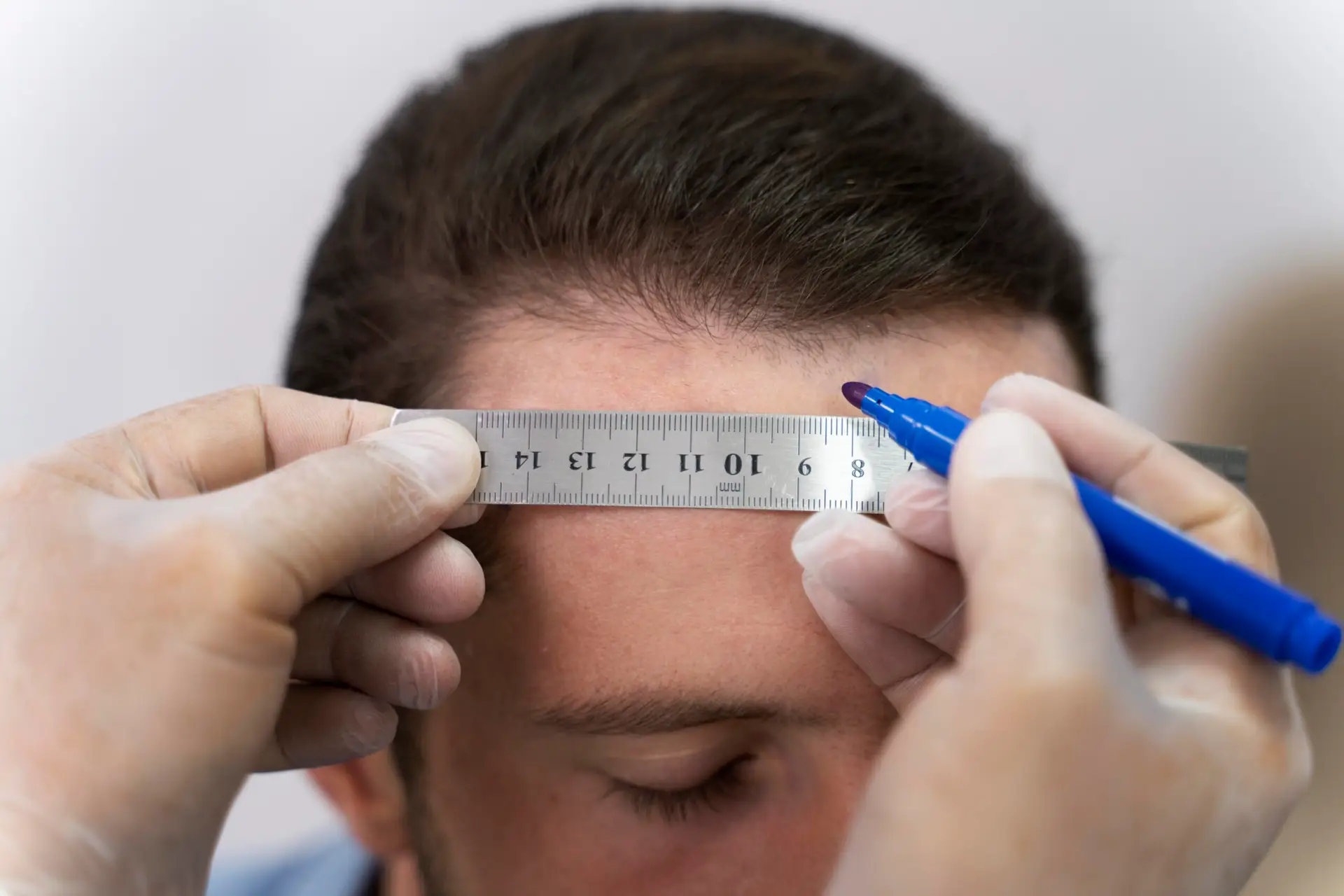 زراعة الشعر في الانيا