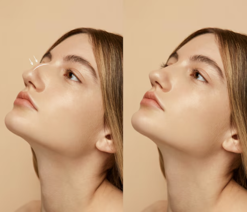تجميل الأنف