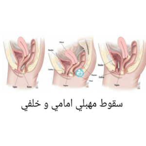 أعراض هبوط المهبل