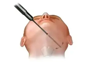 شفط دهون الرقبة وإزالة الذقن المزدوج في 2025