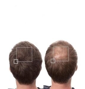 زراعة الشعر لمرضى HIV في تركيا: 7 حقائق مهمة عن الأمان.