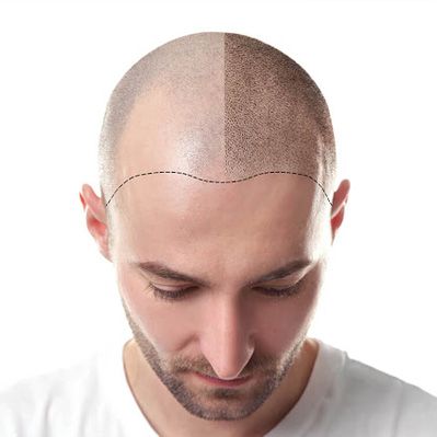 زراعة شعر الجسم في تركيا: 7 حقائق حول التكلفة، ونسبة النجاح