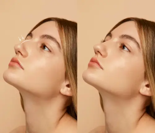 عملية تجميل الأنف