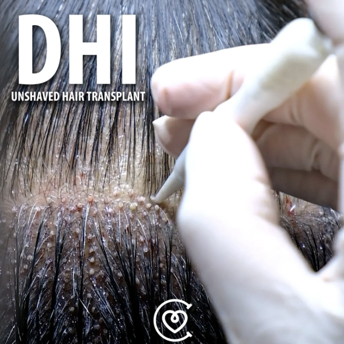 زراعة الشعر المباشرDHI