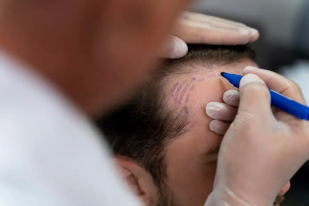 Featured Treatment - Hair Transplant