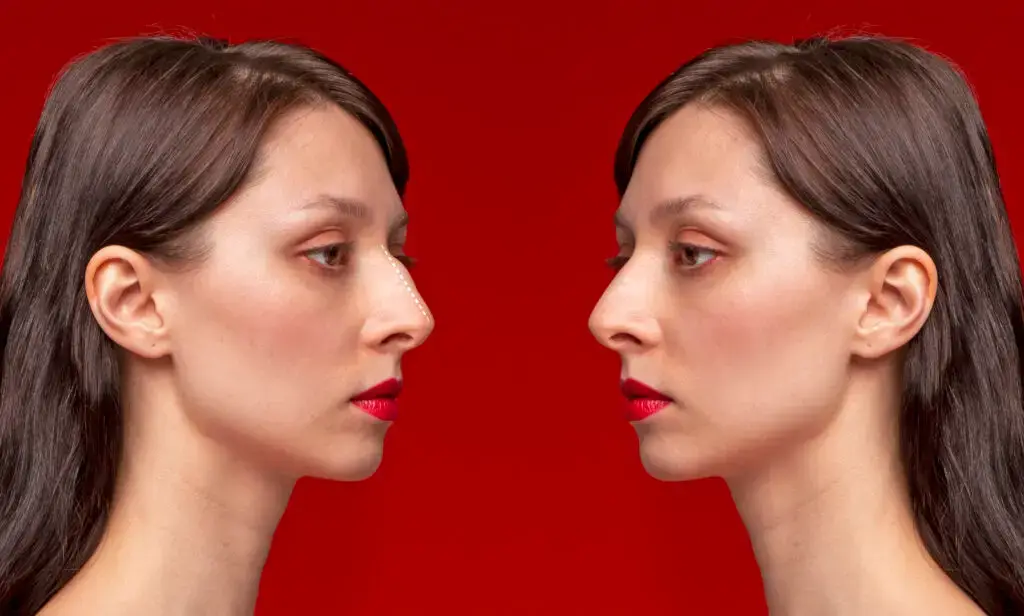 تجميل الأنف