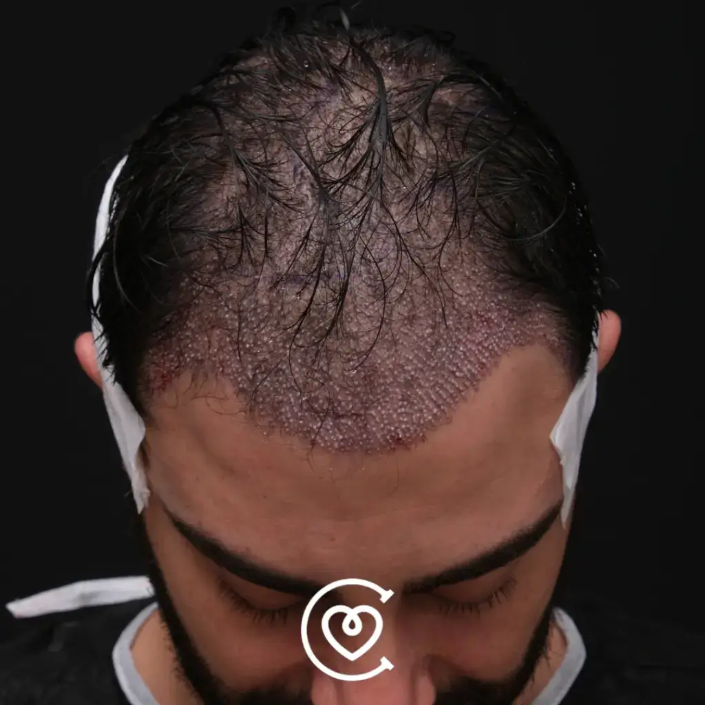 زراعة الشعر بدون حلاقة في تركيا