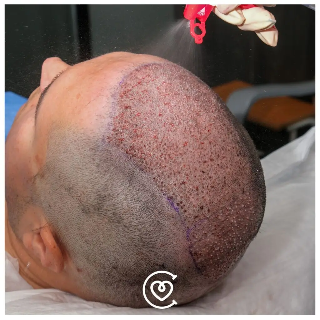 زراعة الشعر