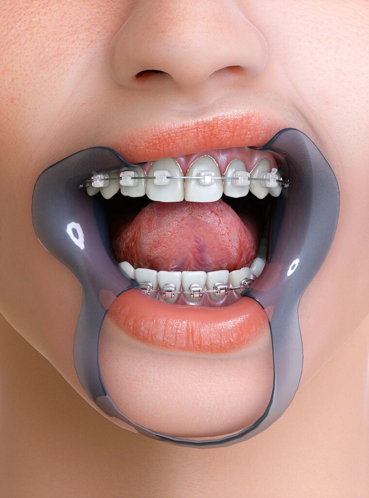 تقويم الأسنان في تركيا: مقارنة التكاليف 2026