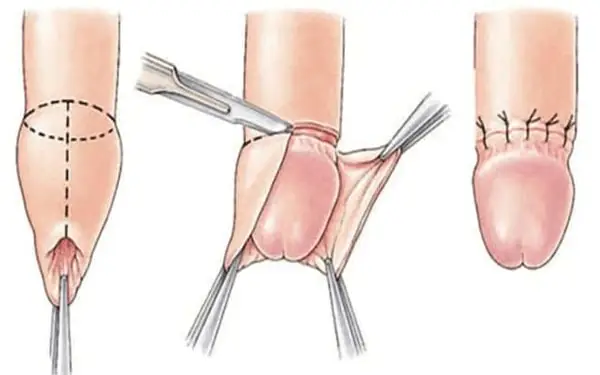 الختان: 5 خطوات للتعافي السريع وآمن