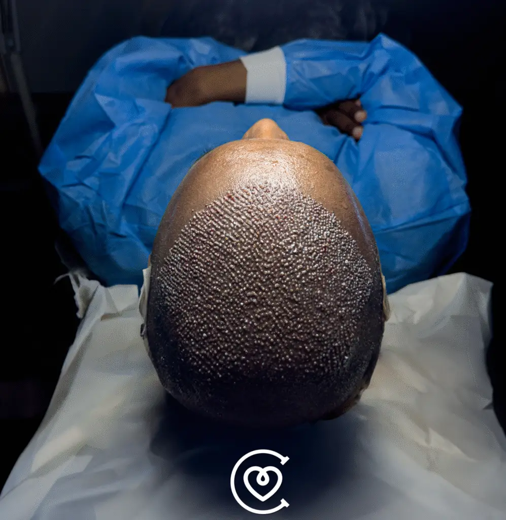 زراعة الشعر