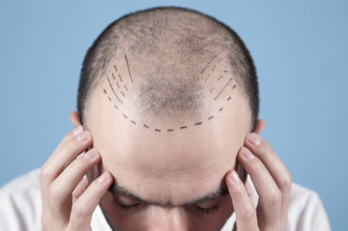 زراعة الشعر