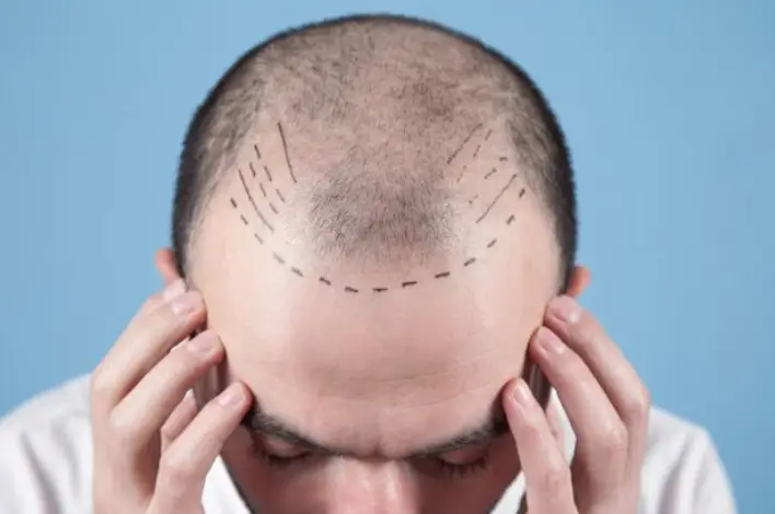 زراعة الشعر