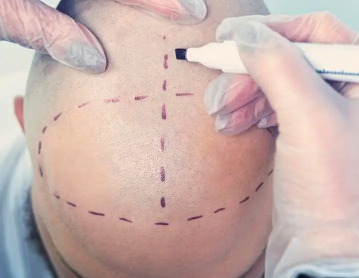 زراعة الشعر في بيليك: 5 أسباب لاختيار تركيا لعمليتك