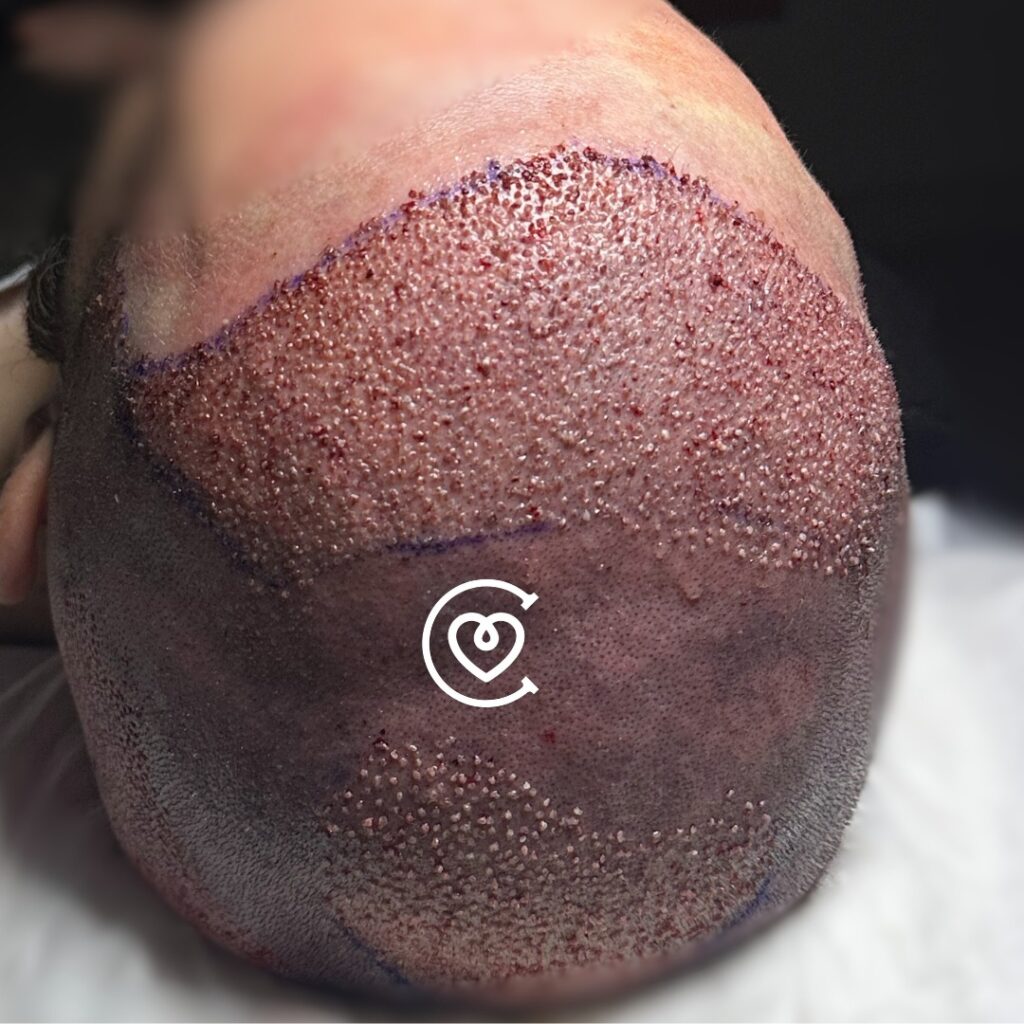 زراعة الشعر