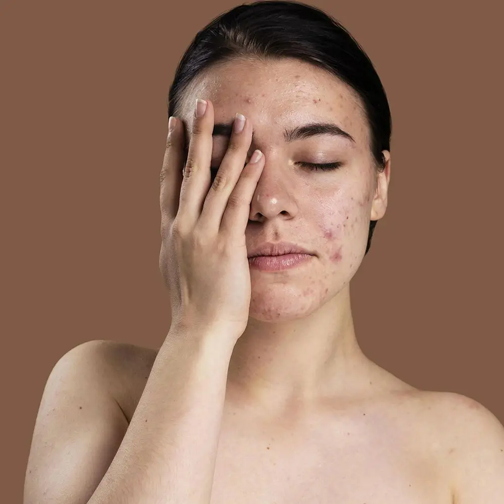 أنواع الليزر وفوائده لعلاج ندوب حب الشباب